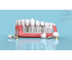 Dental implants chennai