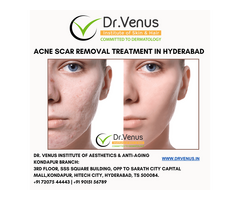 Acne scar removal treatment in Hyderabad